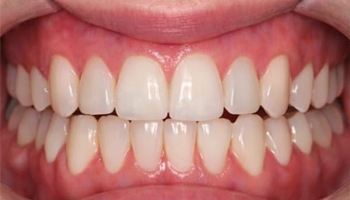Crossbite After.jpg