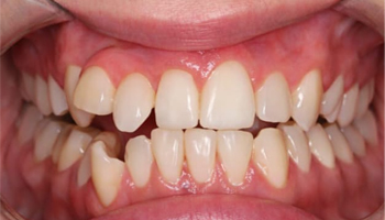 Crossbite Before.jpg