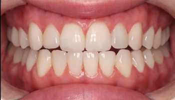 Open bite After.jpg