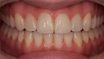 Overbite After.jpg