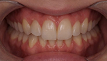 Overbite Before.jpg